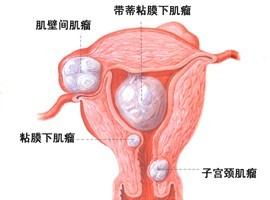 子宫肌瘤示意图