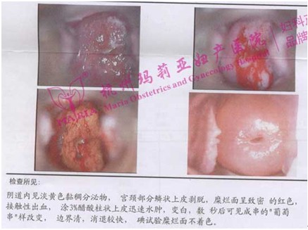 治疗后前后阴道镜检查对比图