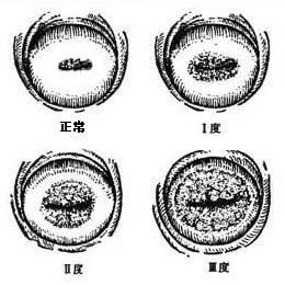 宫颈糜烂病变图示