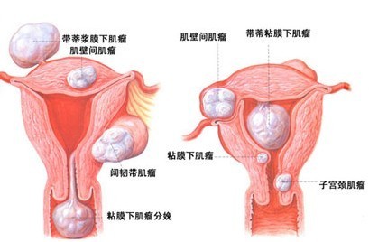 子宫肌瘤