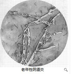 老年性阴道炎